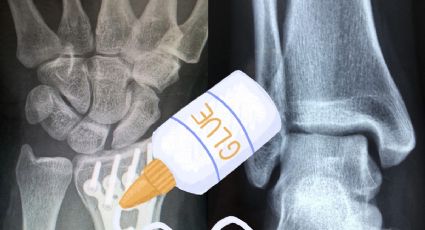 Científicos chinos inventan pegamento para reparar fracturas en solo 3 minutos; ¡sin cirugía!