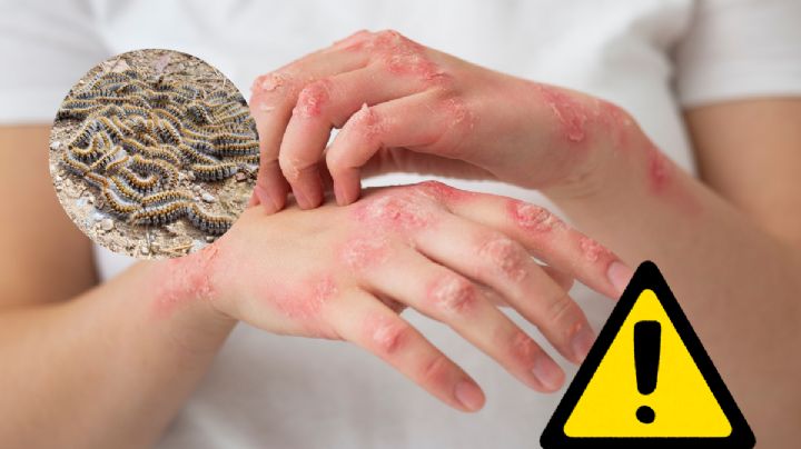 La peligrosa oruga que es tendencia y da dermatitis solo al tocarla